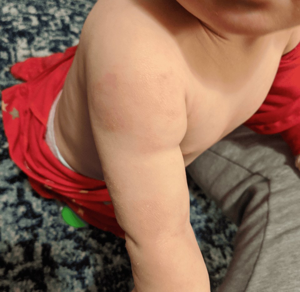 After — infant body eczema